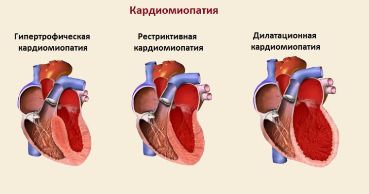 Что такое кардиопатия и кардиомиопатия у детей: причины, симптомы и лечение