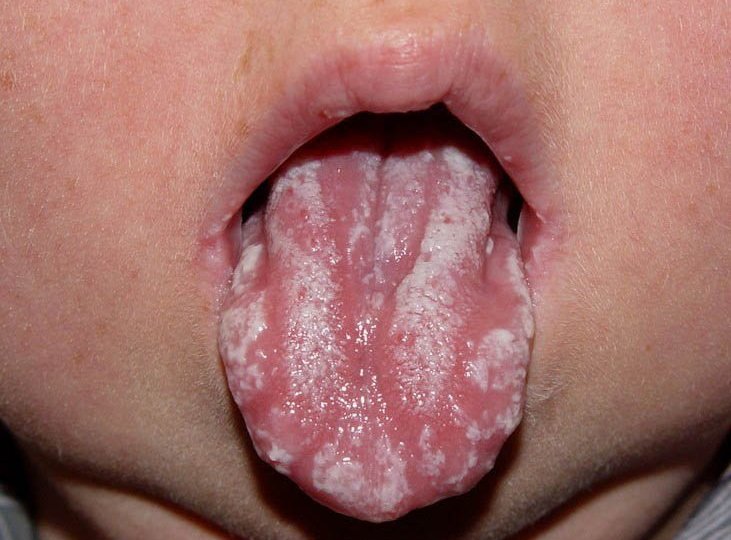 Симптомы стоматита у детей до 1 года, лечение и профилактика заболевания