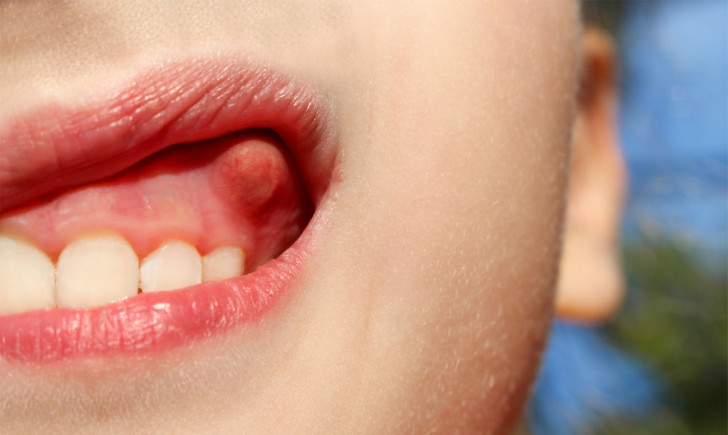 Что делать, если на десне у ребенка появилась шишка: как лечить гнойник над молочным зубом?