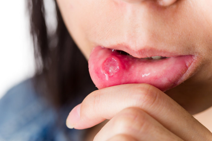 Почему у ребенка может опухнуть верхняя или нижняя губа, каковы особенности лечения?