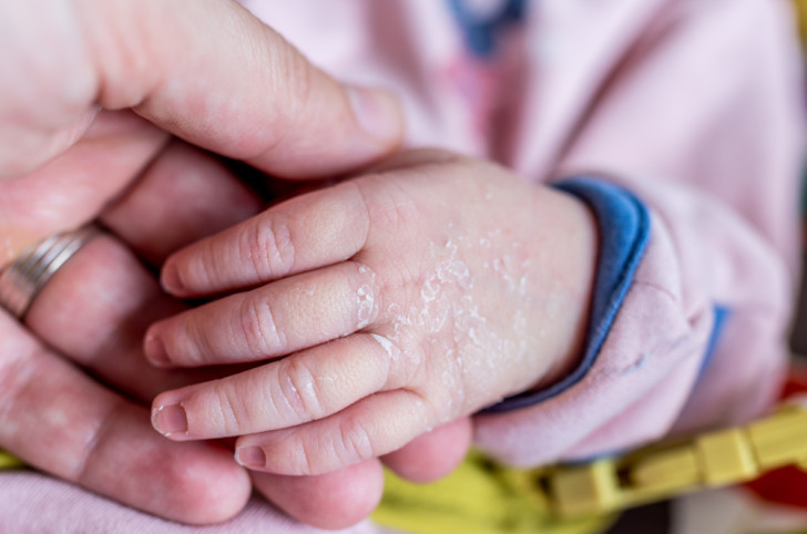Причины шелушения и покраснения кожи у ребенка на ногах, руках, голове и способы лечения