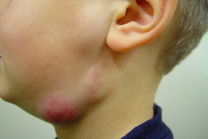 Что делать, если у ребенка на шее увеличены лимфоузлы: причины воспаления и лечение в домашних условиях