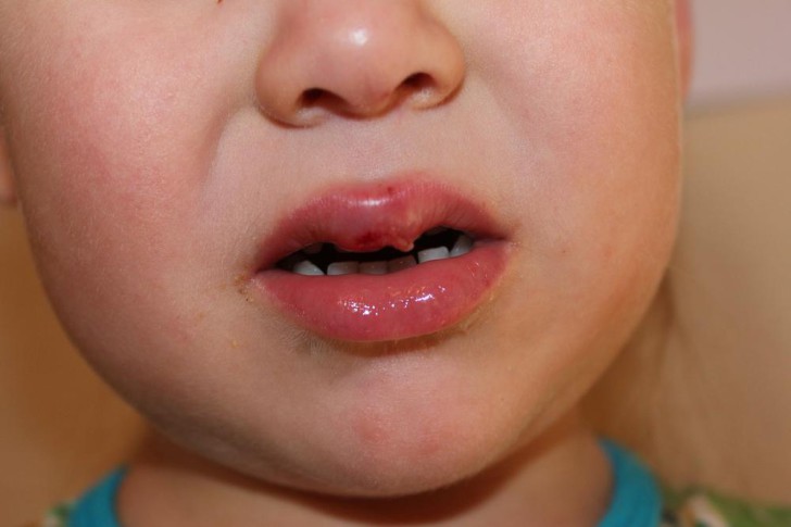 Чем лечить герпес на губе у грудничка и ребенка старше 1 года, каковы симптомы и внешний вид высыпаний?