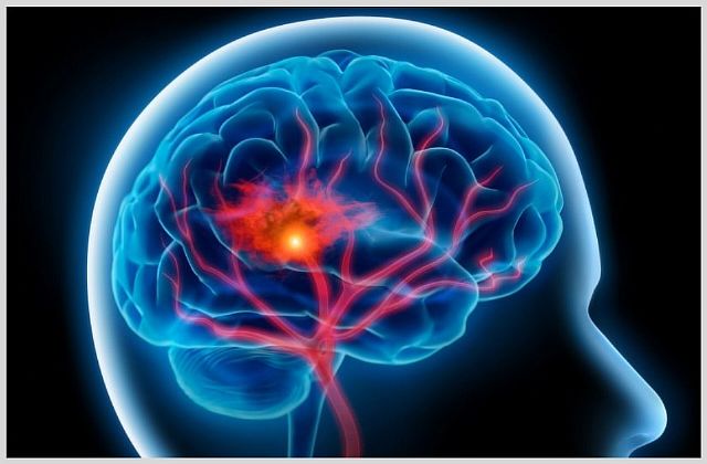 Ишемический инсульт левого полушария головного мозга прогноз
