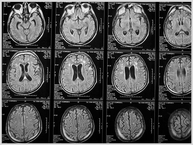 Что такое томография головного мозга