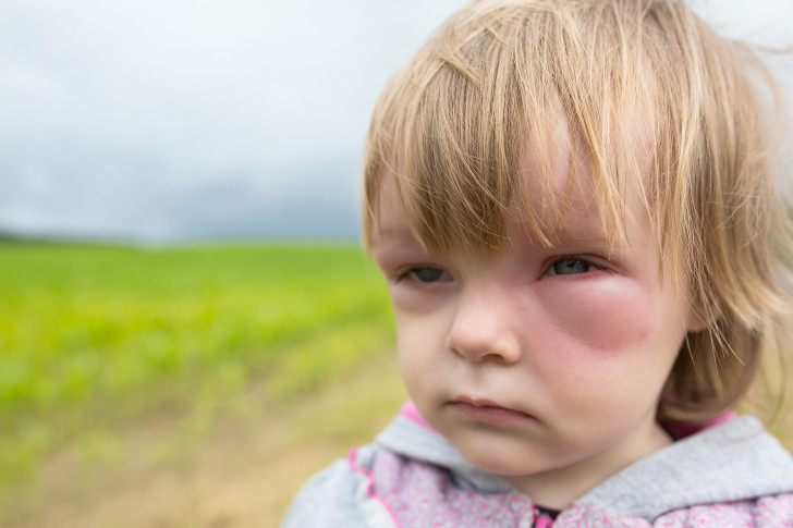 Как выглядит аллергия на коже ребенка: виды и симптомы с фото, лечение и профилактика аллергических реакций