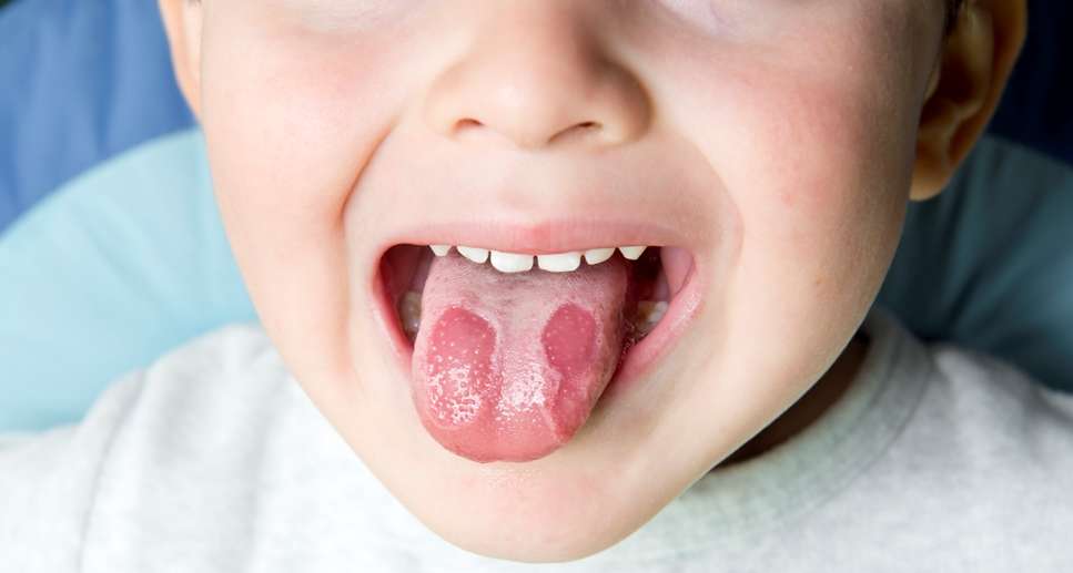 Географические пятна на языке у детей: причины возникновения и способы лечения десквамативного глоссита