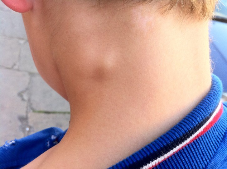 У ребенка на шее под кожей появилась шишка в виде шарика что это может быть?