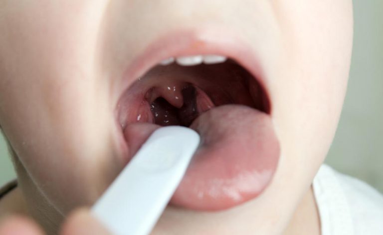 Симптомы и лечение золотистого стафилококка в горле у ребенка: антибиотики и полоскания