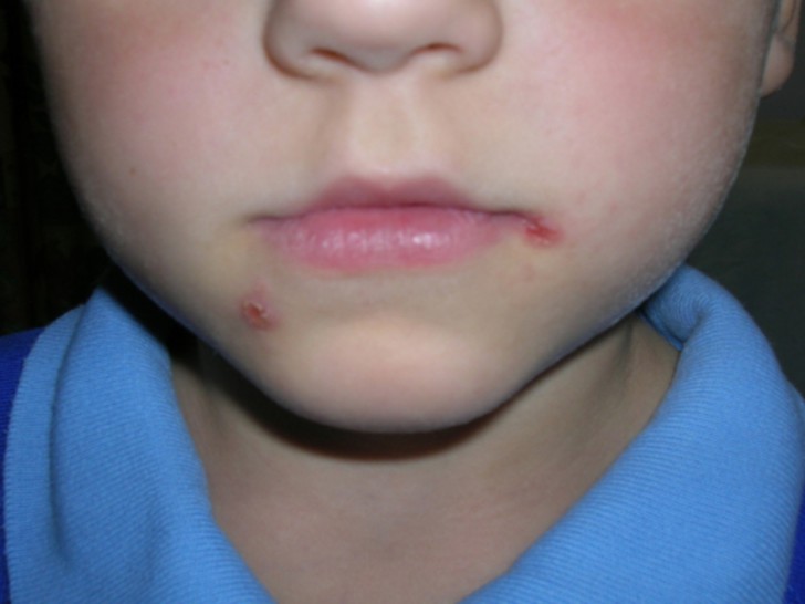 Заеды в уголках рта у детей: причины, симптомы с фото и способы лечения