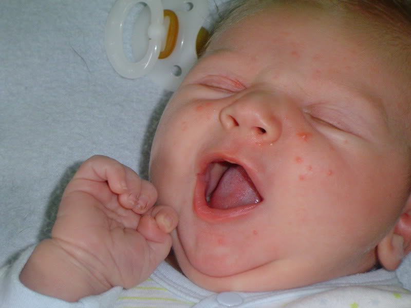 Фото гормональной неонатальной сыпи у новорожденных и ее отличие от других высыпаний