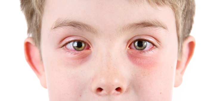 Симптомы и лечение аллергического конъюнктивита у детей
