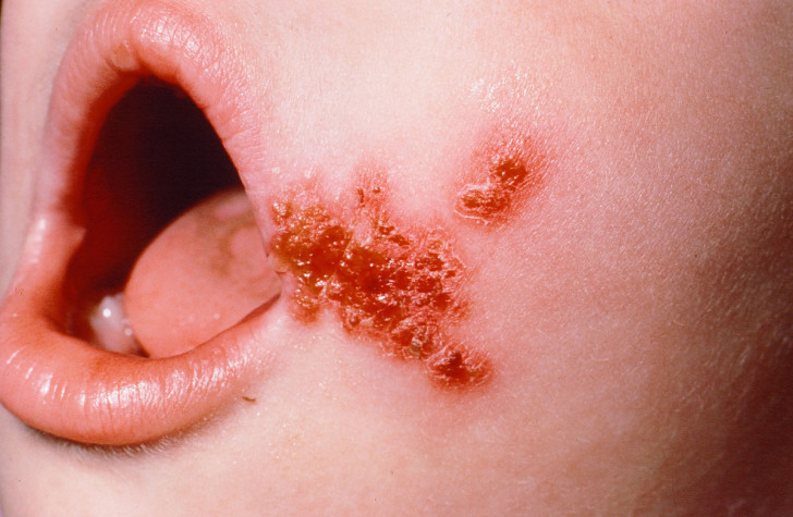 Золотистый стафилококк у ребенка в носу и горле: симптомы и лечение инфекции