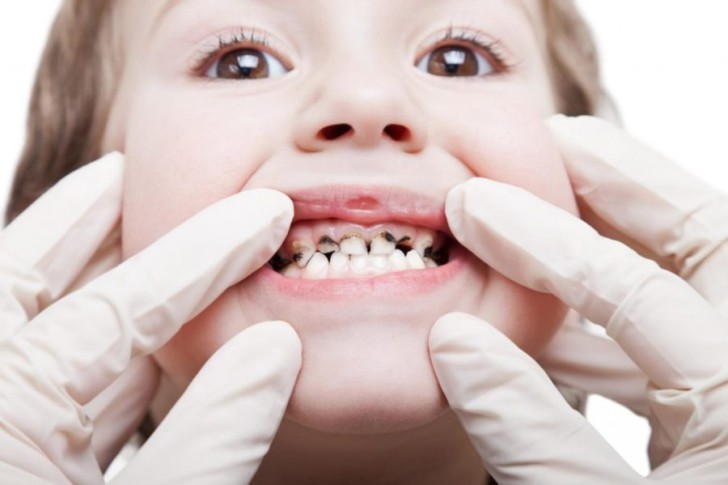 Пульпит молочных зубов у детей: что это такое, какие методы лечения применяют?