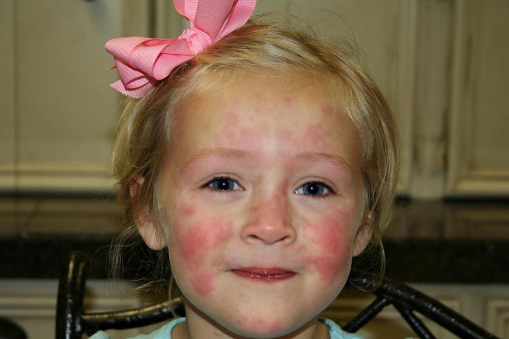 Аллергические пятна на лице у ребенка