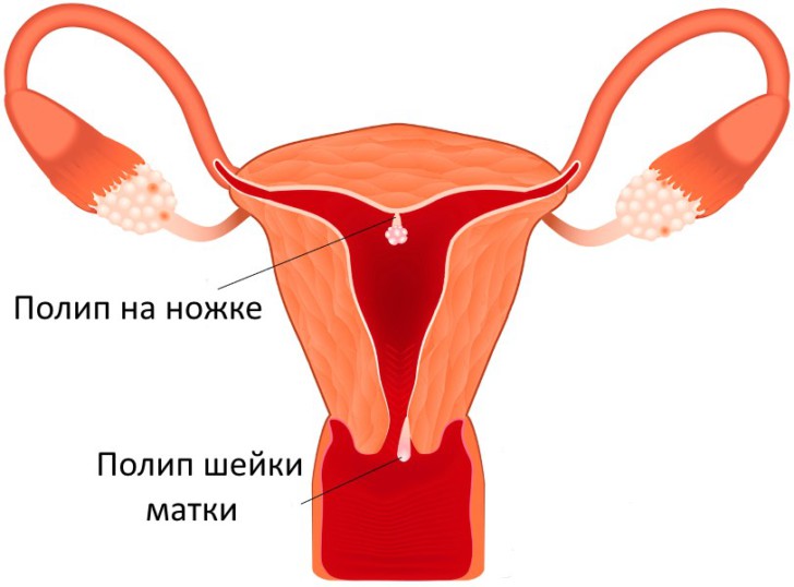 Полип на шейке матки на ранних и поздних сроках беременности: может ли кровить, что делать, чем опасен?