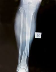 Рентген костей ноги