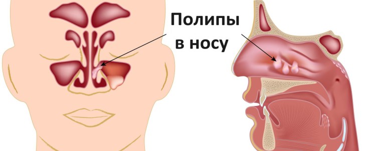 Причины возникновения полипов в носу у ребенка, симптомы с фото и особенности лечения