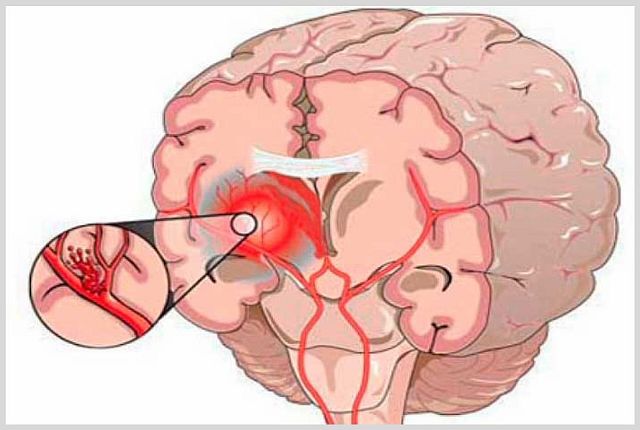 Что такое геморрагический инсульт головного мозга