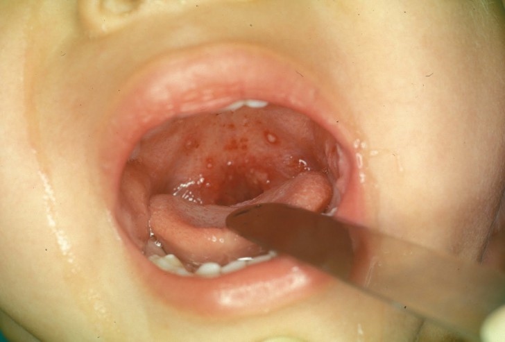 Признаки ангины у маленького ребенка: симптомы с фото горла, лечение и профилактика заболевания