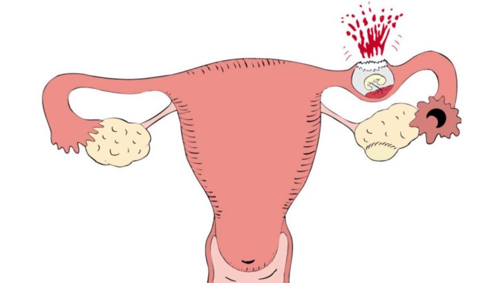 Внематочная беременность после процедуры ЭКО: возможно ли это, какие причины и признаки?