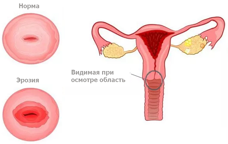 Когда можно забеременеть после процедуры прижигания эрозии шейки матки, как протекает беременность и роды?