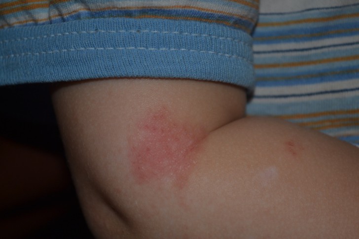У ребенка сыпь на локтях и коленях: причины прыщиков и фото высыпаний с пояснениями