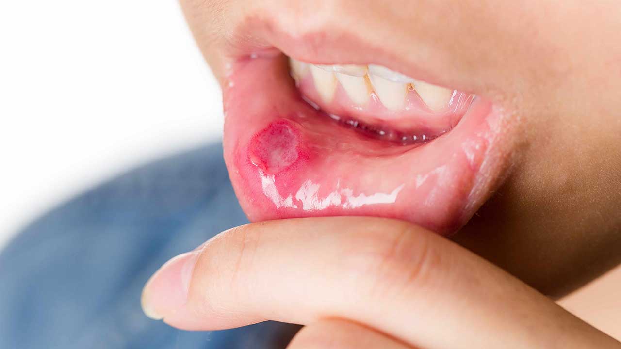 Средства для лечения стоматита во рту у детей: лучшие мази, гели, спреи и таблетки