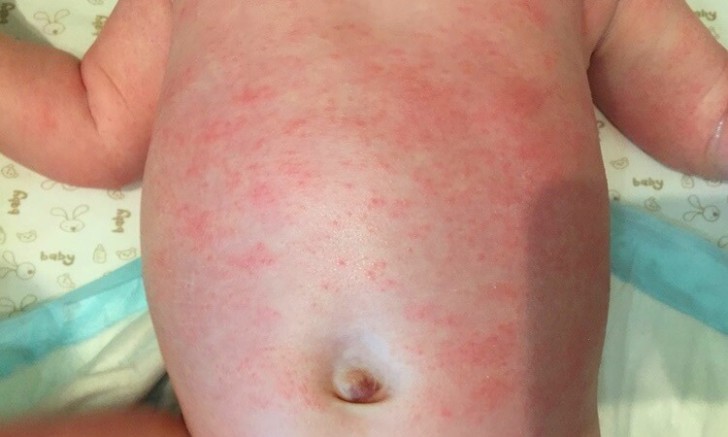 Симптомы аллергии на стиральный порошок у грудничков и детей старшего возраста