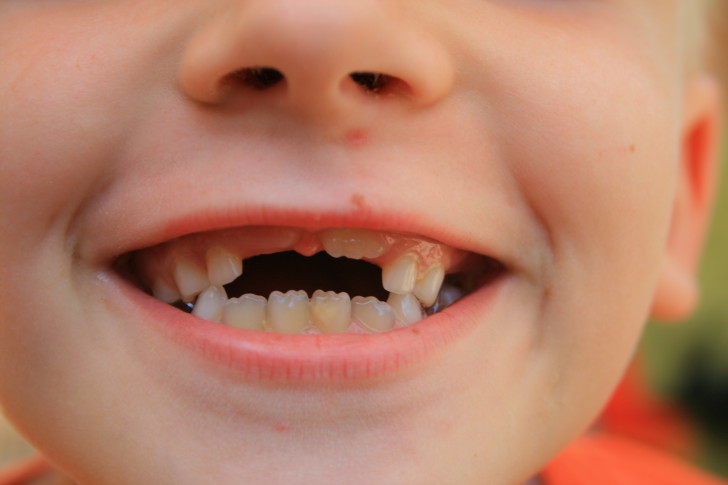 Схема прорезывания постоянных зубов у детей: порядок и сроки смены молочных единиц