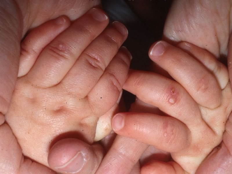 Что такое пузырчатка у новорожденных: фото, симптомы и способы лечения