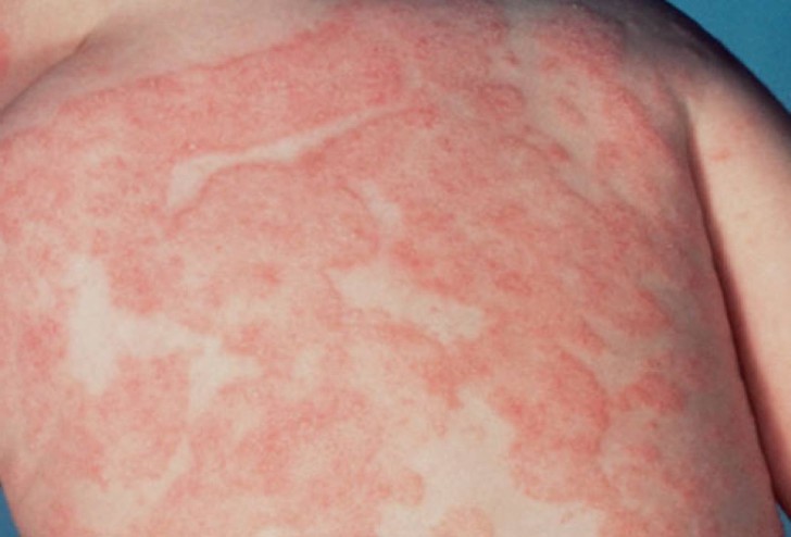 Причины атопического дерматита у детей, симптомы заболевания с фото и особенности лечения
