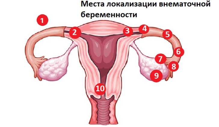 Внематочная беременность на каком сроке можно определить и видно ли по фото на УЗИ?