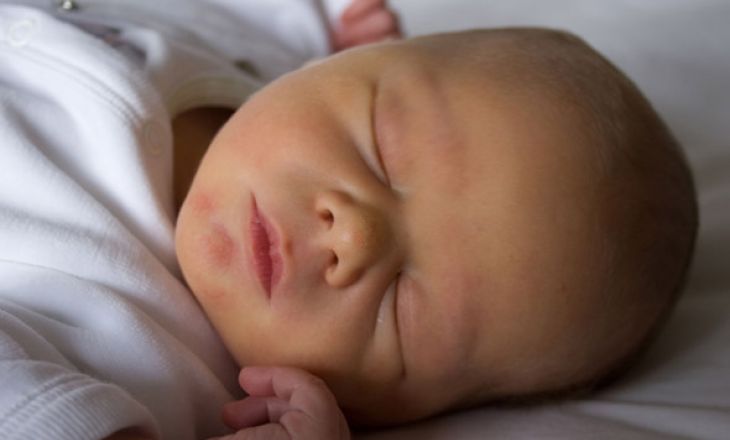 Симптомы и лечение врожденного и приобретенного гипотиреоза у новорожденных и детей от года