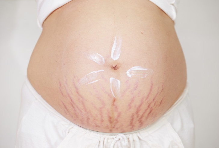 Кремы от растяжек для беременных: обзор самых эффективных косметических средств