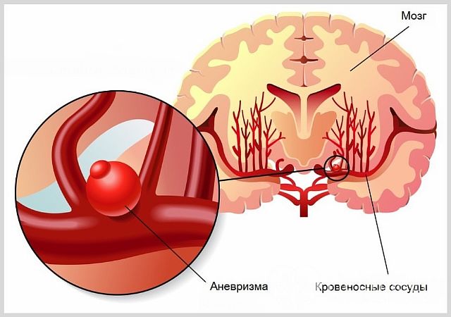 Что такое аневризма головного мозга и ее последствия
