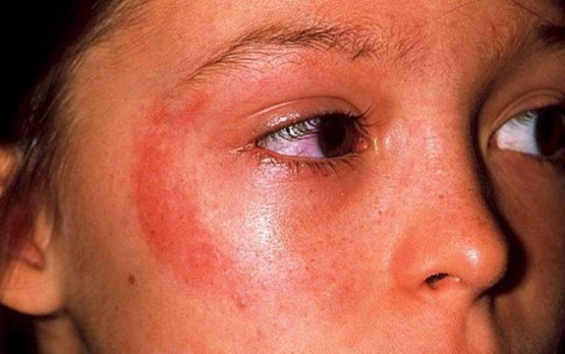 Аллергия на солнце у маленького ребенка: симптомы с фото у грудничка и детей старше 1 года, лечение сыпи