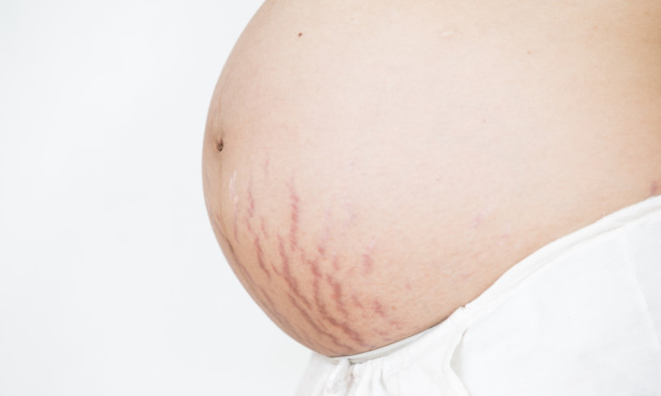 Почему во время беременности появляются растяжки на животе и других зонах, как их избежать и чем можно убрать?