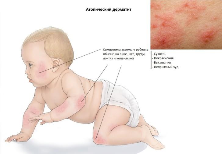 Атопический дерматит у ребенка средства для увлажнения кожи, лечение народной медициной