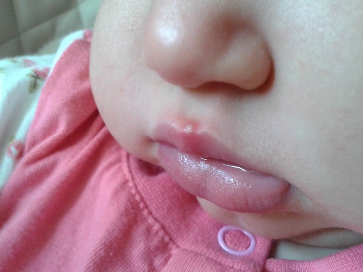 Причины появления мозоли на верхней губе у новорожденного ребенка и грудничка