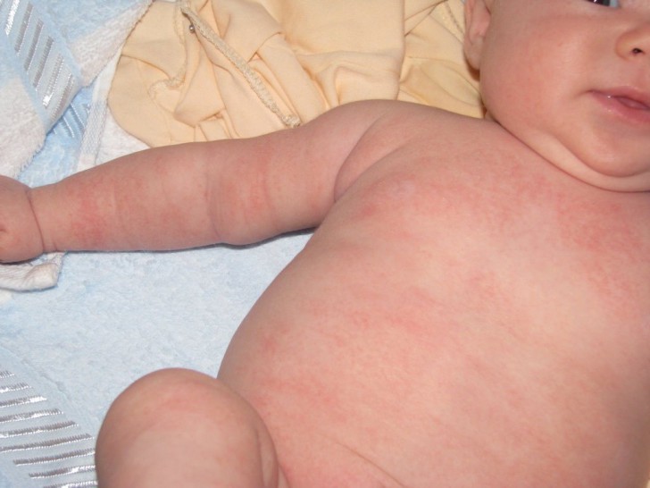 Симптомы крапивницы у грудничков и детей от 3 лет: фото сыпи, лечение в домашних условиях и профилактика