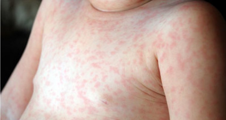 Симптомы розеолы у детей: фото сыпи на начальной стадии, лечение и профилактика трехдневной лихорадки