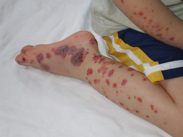 Причины тромбоцитопенической пурпуры у детей и методы лечения заболевания