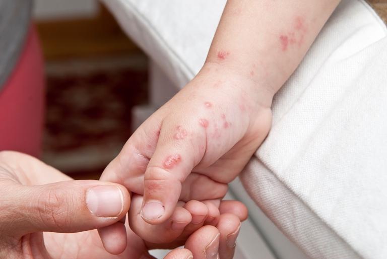 Симптомы опоясывающего лишая у детей, диагностика и схема лечения вируса герпеса