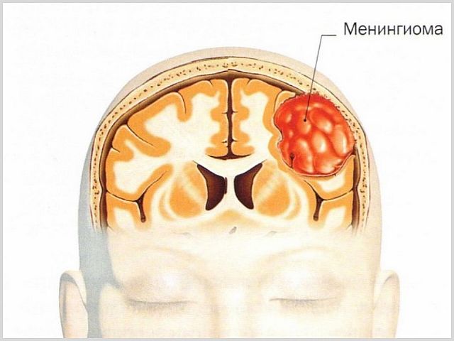 Менингиома головного мозга - что это такое