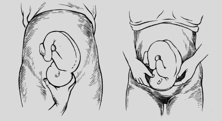 Головное и тазовое предлежание плода при беременности: что это такое и какое положение ребенка соответствует норме?