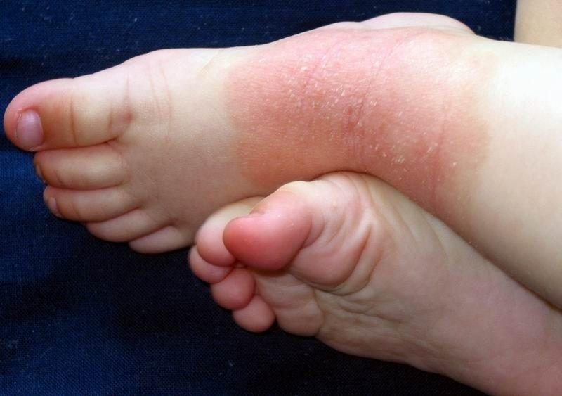 Причины псориаза у детей, фото начальной стадии заболевания и способы лечения