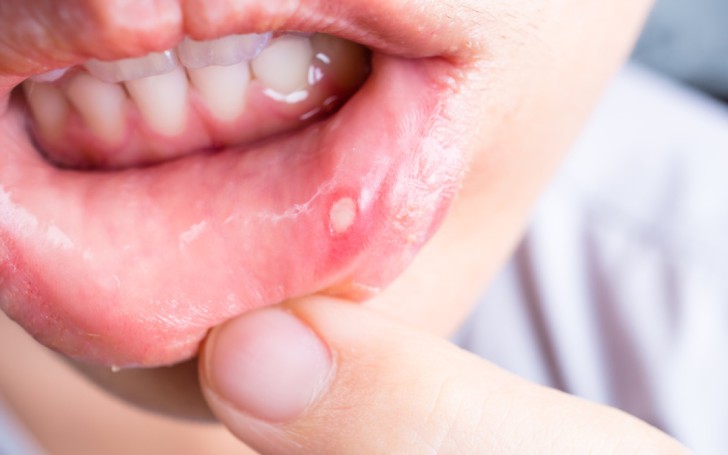 Симптомы стоматита на губе у ребенка, причины и способы лечения заболевания