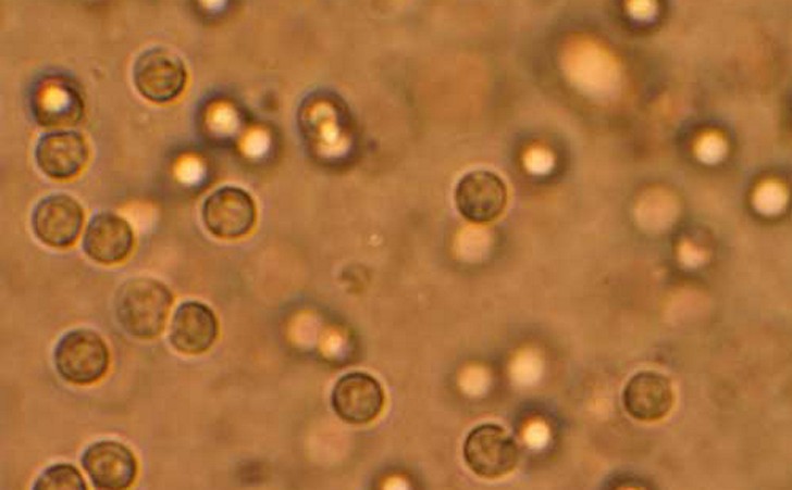 Вид лейкоцитов в детской моче под микроскопом 