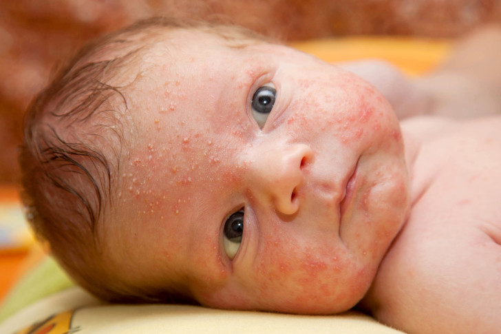 Золотистый стафилококк у ребенка в носу и горле: симптомы и лечение инфекции
